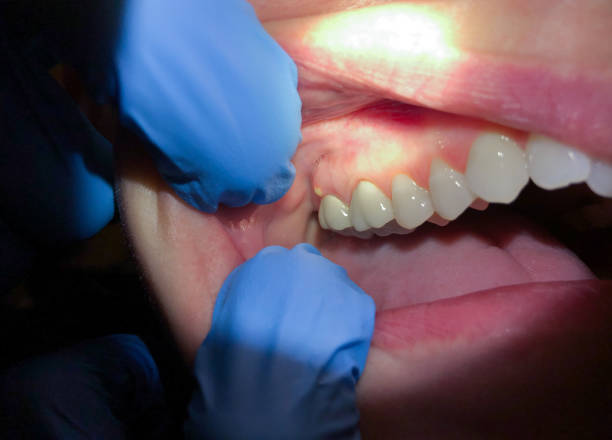 Best Emergency Dental Care for Broken or Chipped Teeth in Cana, VA